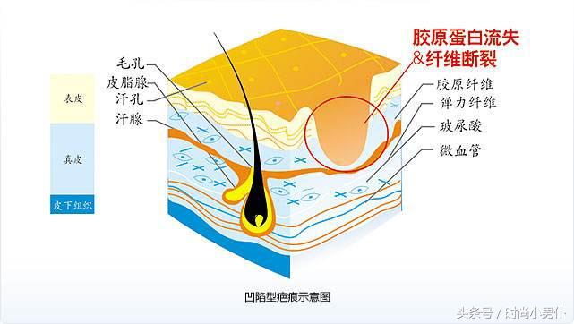 液化性坏死是_液化性坏死_液化性坏死的病理变化