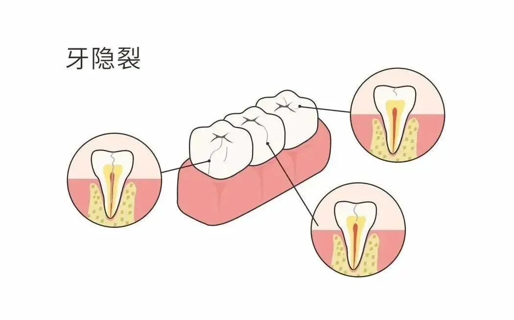 牙齿缝隙黑黑的东西怎么去掉_牙齿缝的黑东西怎么清理_牙齿缝缝里有黑色的怎么去掉